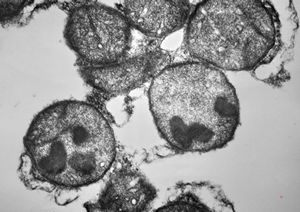 M,2y. | dense mitochondrial inclusions - clinically susp. Zellweger syndrome M,2y. | dense mitochondrial inclusions - clinically susp. Zellweger syndrome